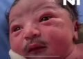 A baby was born with full facial hair this morning