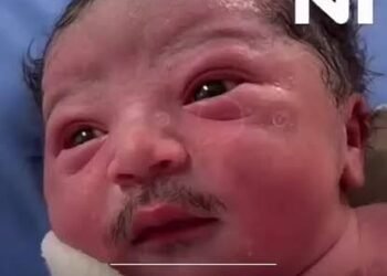 A baby was born with full facial hair this morning