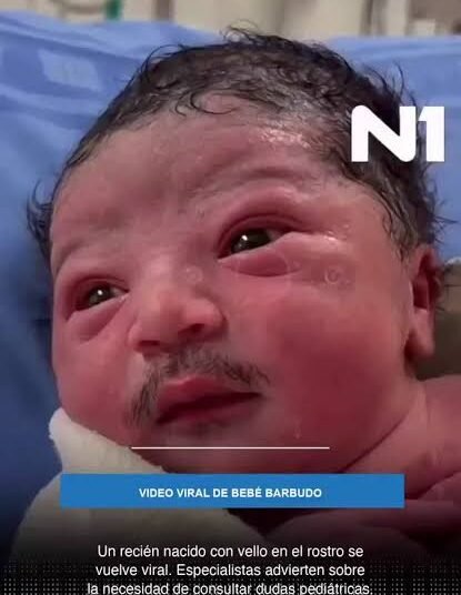 A baby was born with full facial hair this morning