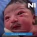 A baby was born with full facial hair this morning